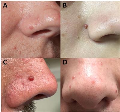 Beyond the “3 Ps”: A critical appraisal of the non-endocrine manifestations of multiple endocrine neoplasia type 1